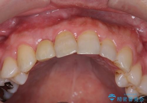 [ 骨造成を伴う前歯審美インプラント② ] ジルコニアカスタムアバットメント・クラウンの作製の治療後