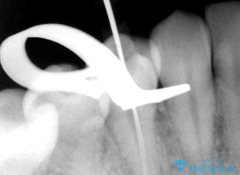 抜歯の提案を受けて、それが受け入れられずに転院されてきたケース:右下4番の歯の神経が壊死してしまったことによる根尖性歯周炎に対する精密根管治療(イニシャルトリートメント)ケースの治療中