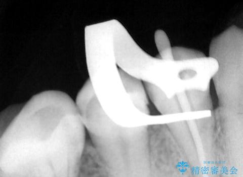 抜歯の提案を受けて、それが受け入れられずに転院されてきたケース:右下4番の歯の神経が壊死してしまったことによる根尖性歯周炎に対する精密根管治療(イニシャルトリートメント)ケースの治療中
