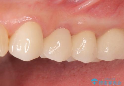 歯ぎしりで歯がグラグラ　噛み合わせを改善するブリッジ治療の治療後
