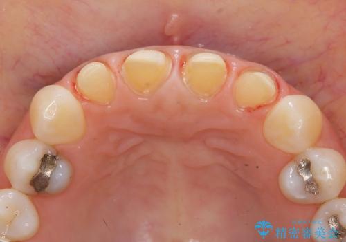 [オールセラミックジルコニアクラウン]  前歯の見た目改善セラミック治療の治療中