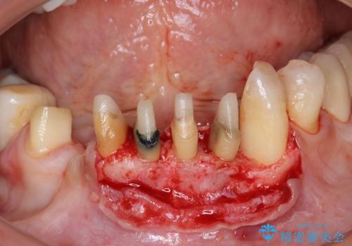 [ 前歯の歯周病治療① ]  再生治療・歯周ポケット除去の治療後