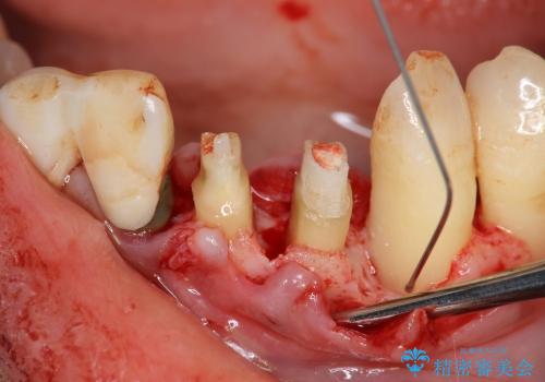 [ 前歯の歯周病治療① ]  再生治療・歯周ポケット除去の治療中