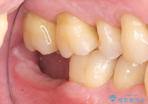 失った奥歯　インプラントによる咬合機能回復の治療前