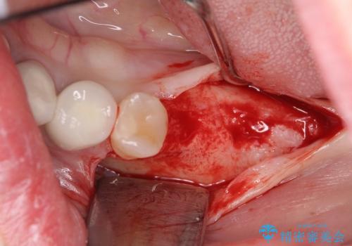 インプラントによる奥歯の咬合機能回復　クラウン高径のない場合骨外科による対応の治療中