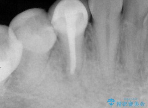 抜歯の提案を受けて、それが受け入れられずに転院されてきたケース:右下4番の歯の神経が壊死してしまったことによる根尖性歯周炎に対する精密根管治療(イニシャルトリートメント)ケースの治療後