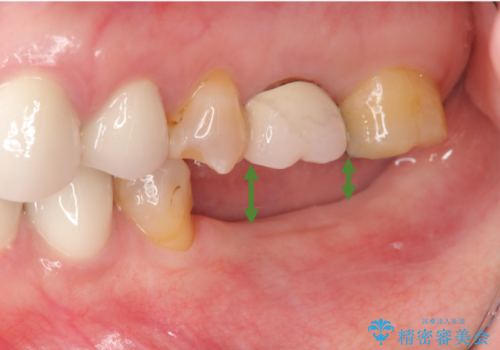 インプラントによる奥歯の咬合機能回復　クラウン高径のない場合骨外科による対応の治療中