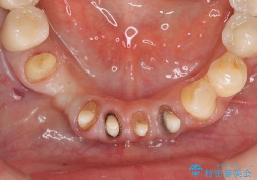 [ 前歯の歯周病治療② ]  再生治療後の歯ぐきの治癒・セラミッククラウンの作製の治療中