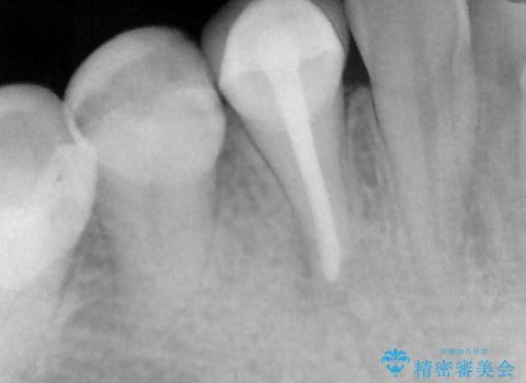 抜歯の提案を受けて、それが受け入れられずに転院されてきたケース:右下4番の歯の神経が壊死してしまったことによる根尖性歯周炎に対する精密根管治療(イニシャルトリートメント)ケースの治療後