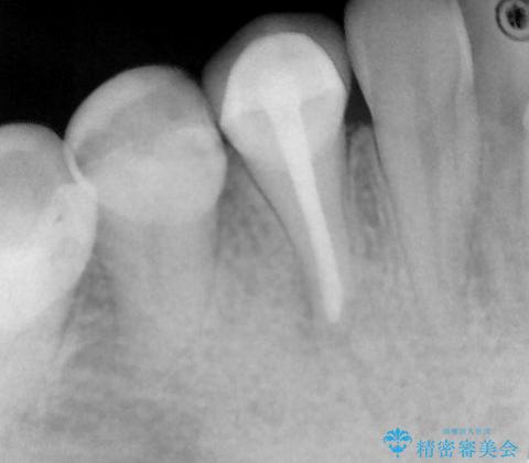 抜歯の提案を受けて、それが受け入れられずに転院されてきたケース：右下４番の歯の神経が壊死してしまったことによる根尖性歯周炎に対する精密根管治療(イニシャルトリートメント)ケース