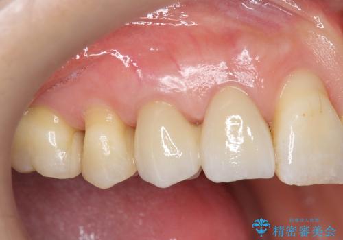 [歯の金属色を改善]　前歯の審美セラミック治療の治療後