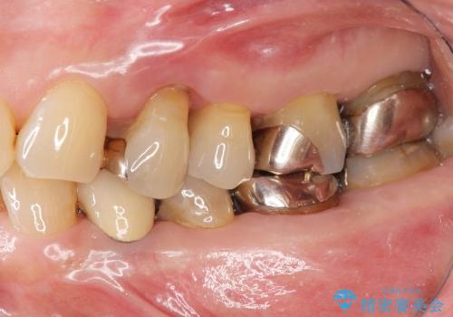 歯ぎしりで歯がグラグラ　噛み合わせを改善するブリッジ治療の治療前