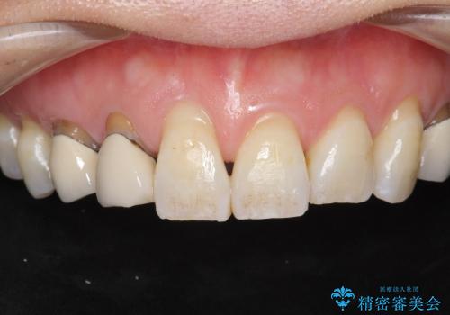 [歯の金属色を改善]　前歯の審美セラミック治療の治療前