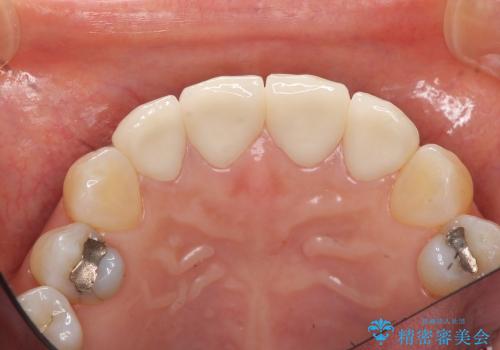 [オールセラミックジルコニアクラウン]  前歯の見た目改善セラミック治療の治療後