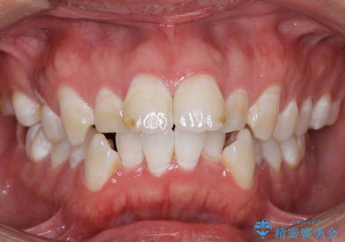 30代男性　虫歯で失った歯の隙間を矯正で閉じたの治療前