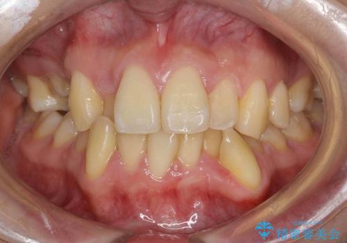 30代女性　乳歯が残っている　歯肉退縮した犬歯を抜歯　妊娠・出産も問題ありませんの治療前