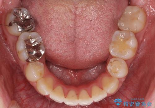 八重歯　神経のない奥の歯を抜歯の治療後