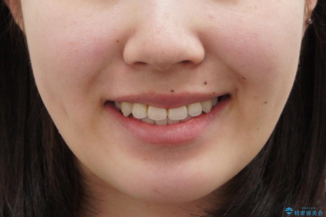 八重歯　神経のない奥の歯を抜歯の治療後（顔貌）