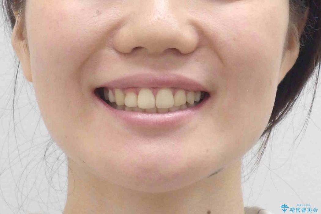 前歯が反対になっている　オーソドックスなワイヤー矯正の治療後（顔貌）