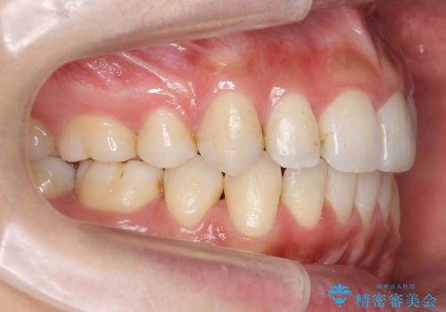 30代女性　重度の出っ歯を美しくの治療後