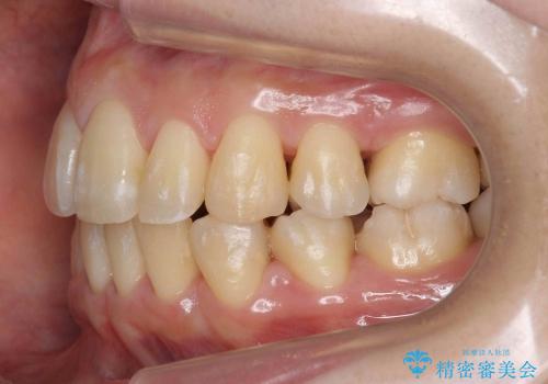 30代女性　乳歯が残っている　歯肉退縮した犬歯を抜歯　妊娠・出産も問題ありませんの治療後