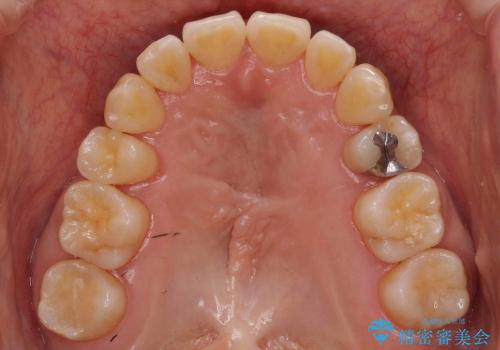 30代女性　乳歯が残っている　歯肉退縮した犬歯を抜歯　妊娠・出産も問題ありませんの治療後