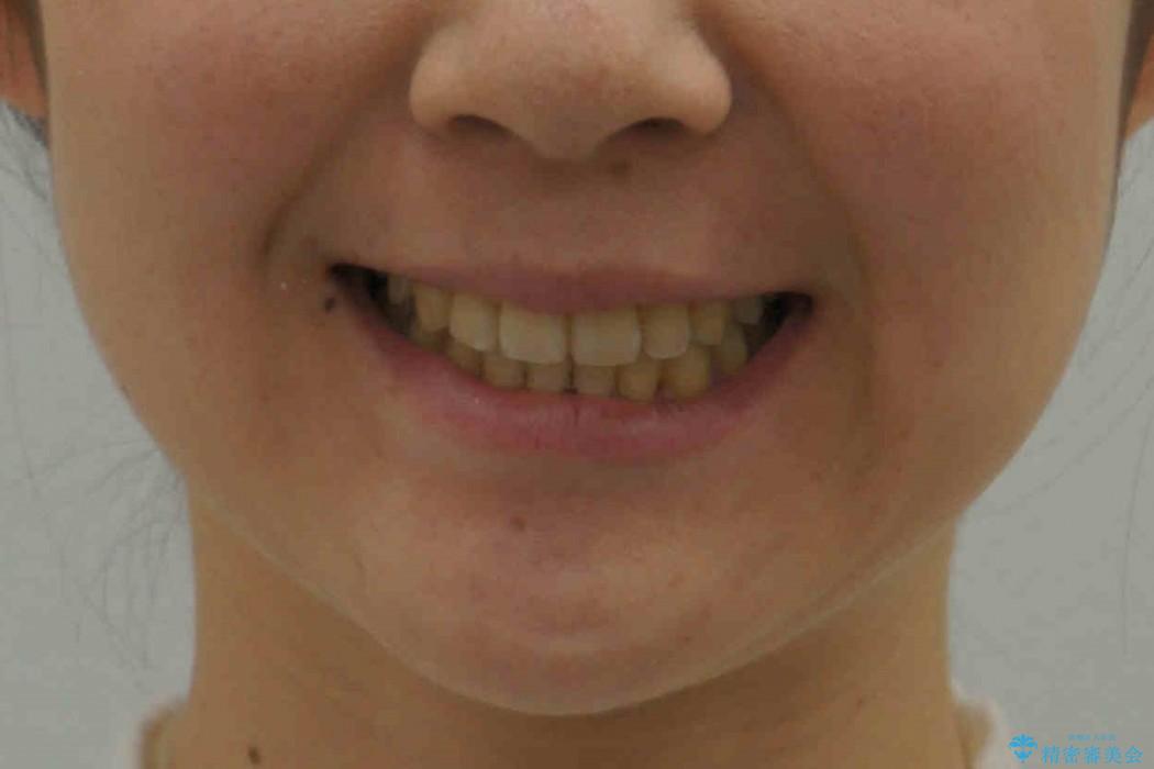 30代女性　乳歯が残っている　歯肉退縮した犬歯を抜歯　妊娠・出産も問題ありませんの治療後（顔貌）
