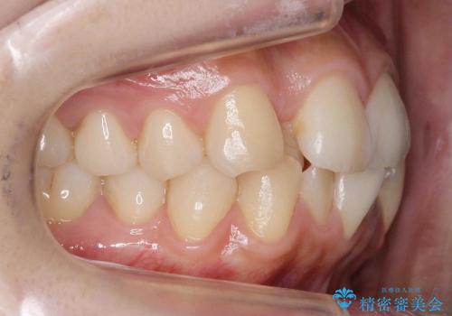 前歯が反対になっている　オーソドックスなワイヤー矯正の治療前