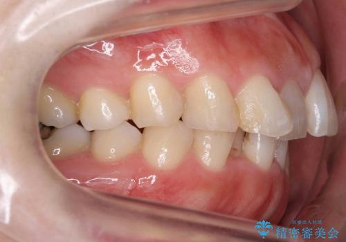30代女性　前歯の著しいがたがた　親知らずを活用の治療前