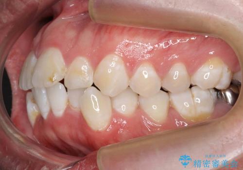30代男性　虫歯で失った歯の隙間を矯正で閉じたの治療前