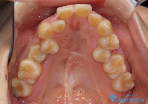 30代女性　乳歯が残っている　歯肉退縮した犬歯を抜歯　妊娠・出産も問題ありませんの治療前