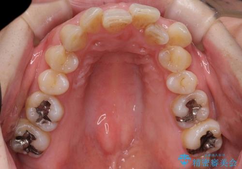 30代女性　前歯の著しいがたがた　親知らずを活用の治療前