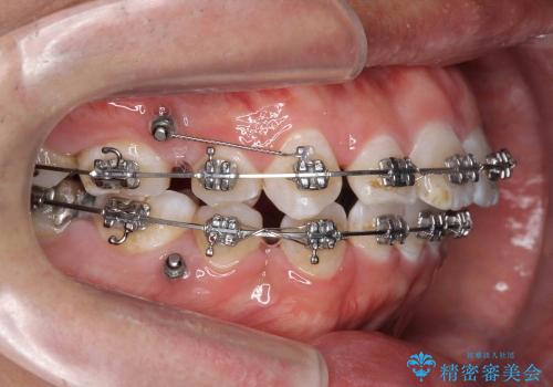 30代男性　虫歯で失った歯の隙間を矯正で閉じたの治療中