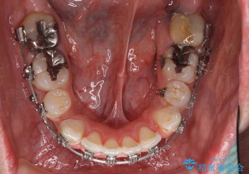 30代男性　虫歯で失った歯の隙間を矯正で閉じたの治療中