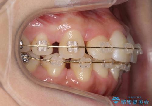 前歯が反対になっている　オーソドックスなワイヤー矯正の治療中