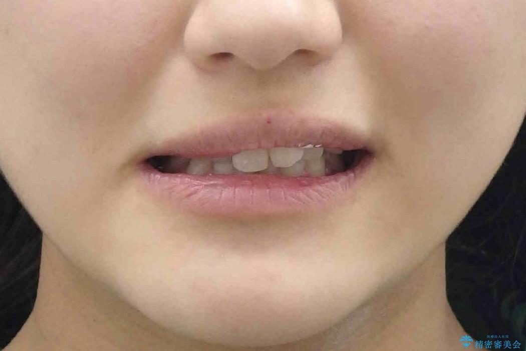 [大きい正中のずれ] 裏側矯正で前歯のねじれ・顎のゆがみを改善の治療前（顔貌）