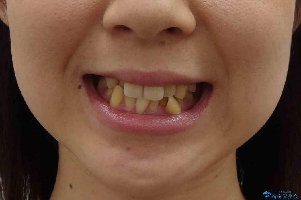 30代女性　乳歯が残っている　歯肉退縮した犬歯を抜歯　妊娠・出産も問題ありませんの治療前（顔貌）