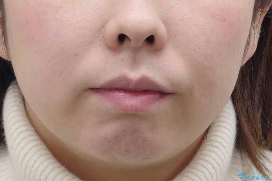 30代女性　前歯の著しいがたがた　親知らずを活用の治療前（顔貌）