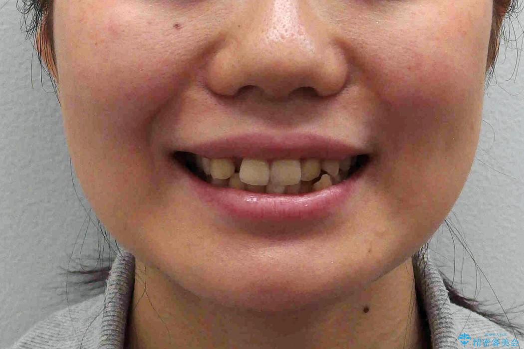 前歯が反対になっている　オーソドックスなワイヤー矯正の治療前（顔貌）
