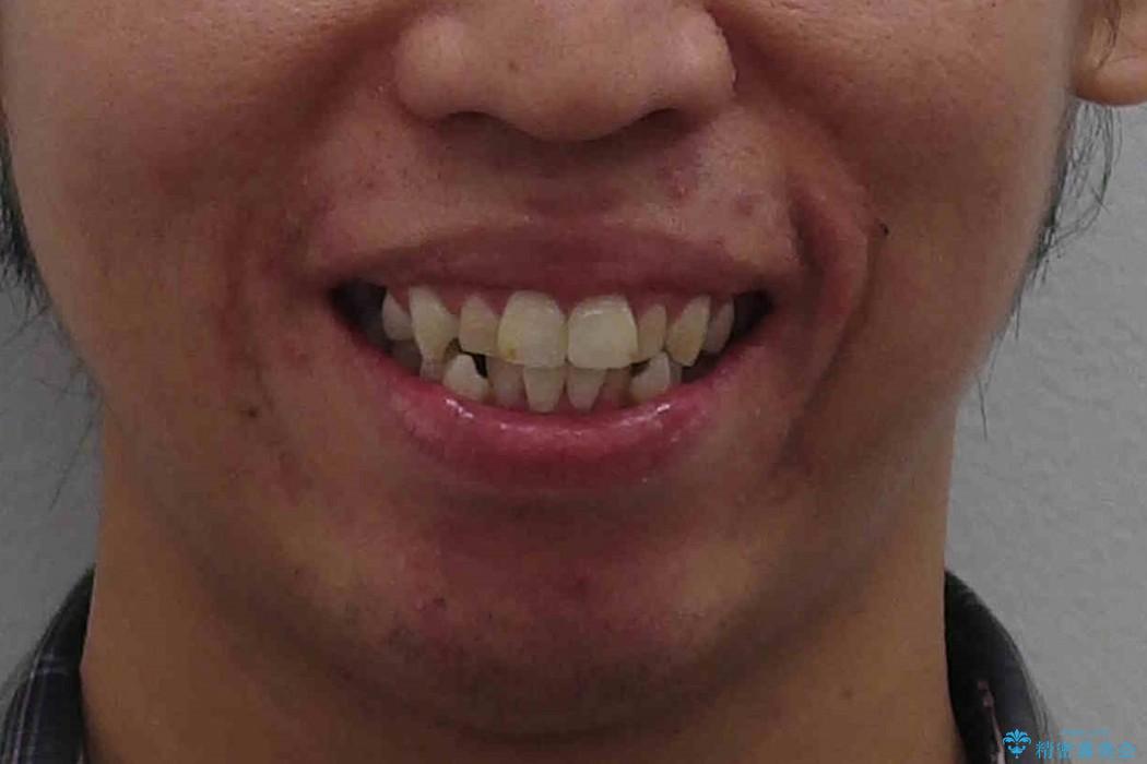 30代男性　虫歯で失った歯の隙間を矯正で閉じたの治療前（顔貌）