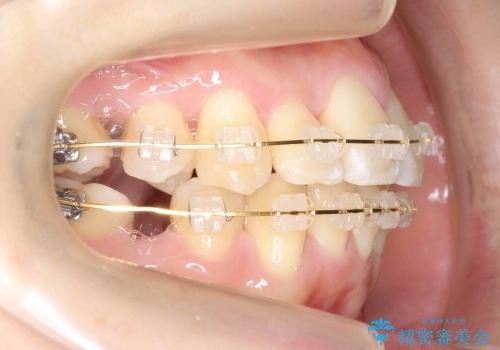 30代女性　乳歯が残っている　歯肉退縮した犬歯を抜歯　妊娠・出産も問題ありませんの治療中
