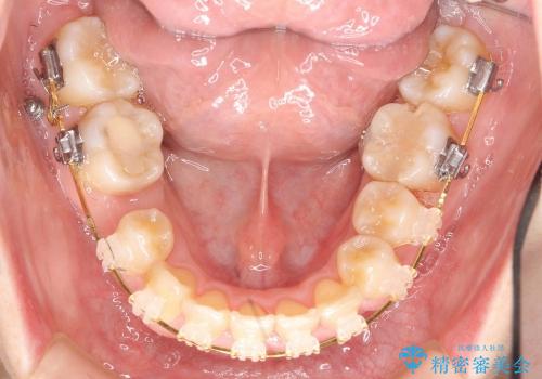 30代女性　乳歯が残っている　歯肉退縮した犬歯を抜歯　妊娠・出産も問題ありませんの治療中
