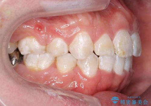 30代男性　虫歯で失った歯の隙間を矯正で閉じたの治療後