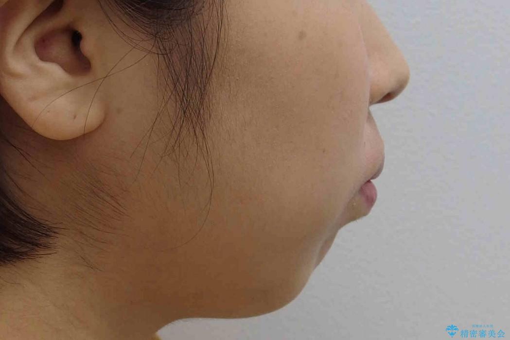 30代女性　重度の出っ歯を美しくの治療前（顔貌）