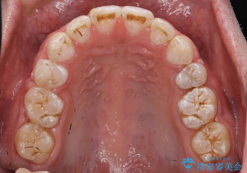 30代男性　虫歯で失った歯の隙間を矯正で閉じたの治療後