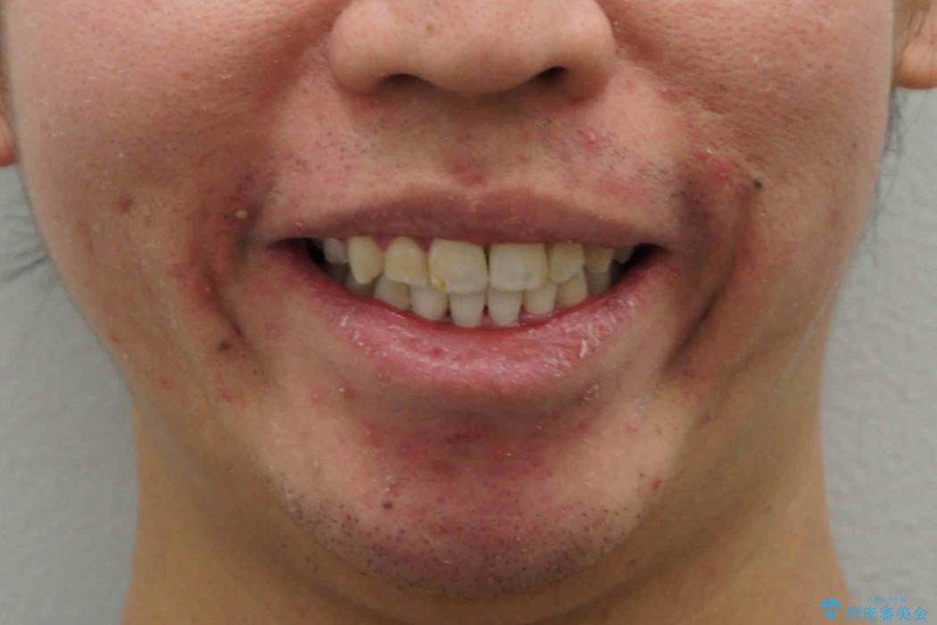 30代男性　虫歯で失った歯の隙間を矯正で閉じたの治療後（顔貌）