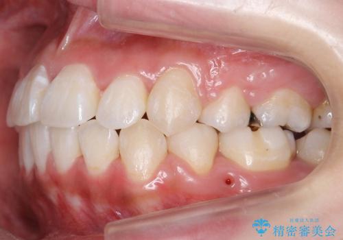 八重歯　神経のない奥の歯を抜歯の治療後