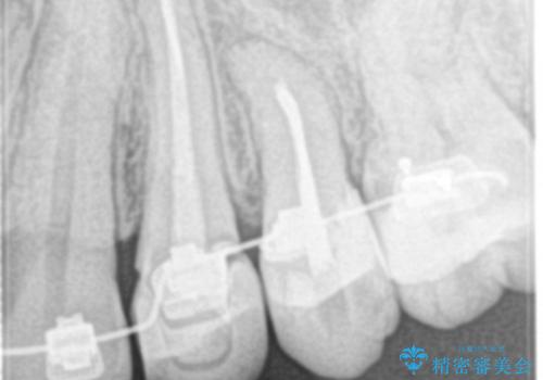 矯正治療前の根管治療 : 歯髄の壊死により、根の先に膿が生じ、歯ぐきに膿の出口ができていたケースへのイニシャルトリートメントの治療後