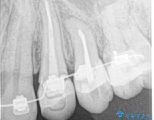 歯髄の壊死により、根の先に膿が生じ、歯ぐきに膿の出口ができていたケースへの根管治療(イニシャルトリートメント)