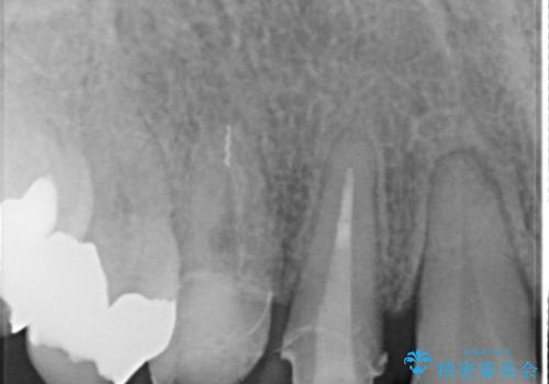 [歯の金属色を改善]　前歯の審美セラミック治療の治療中